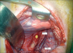 Image of Esophageal Atresia