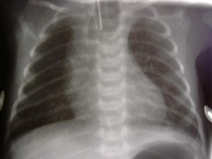 Picture of Esophageal Atresia