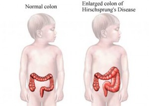 Picture of Hirschsprung Disease