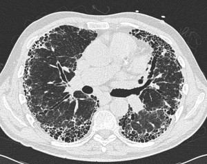 Image of Idiopathic Pulmonary Fibrosis
