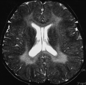 Picture of Metachromatic Leukodystrophy 