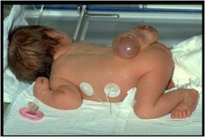 Image of Neural tube defect