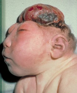 Picture of Neural tube defect