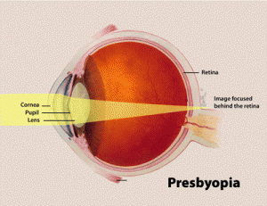 Picture of Presbyopia