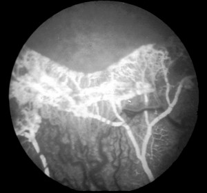 Image of Retinopathy of prematurity