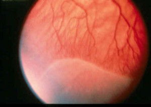 Picture of Retinopathy of prematurity