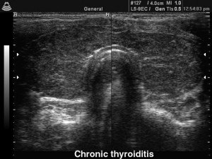 Picture of Thyroiditis