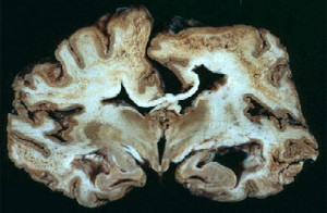 Image of Creutzfeldt-jakob disease