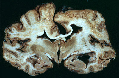 Creutzfeldt-jakob disease