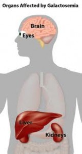 Picture of Galactosemia