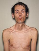 Picture of Myotonic dystrophy