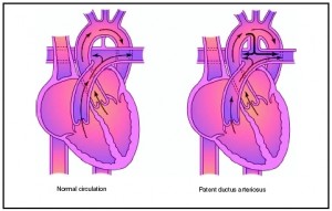 Picture of Patent ductus arteriosus