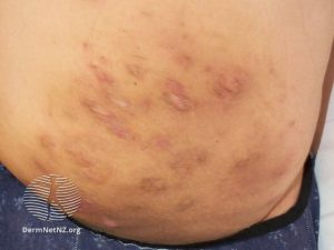 hidradenitis suppurativa