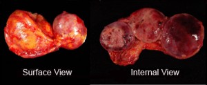 Image of Pheochromocytoma