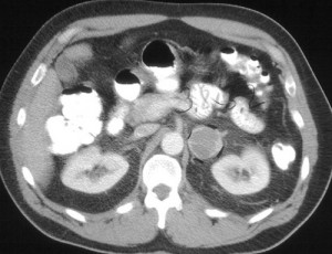 Picture of Pheochromocytoma