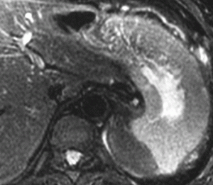 Image of Zollinger-ellison Syndrome