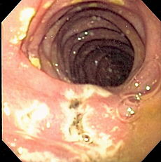 Picture of Zollinger-ellison Syndrome