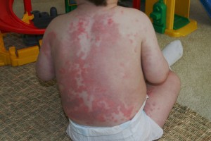 Picture of Erythema multiforme