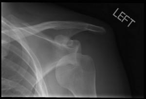 Picture of Dislocated shoulder