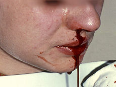 Picture of Epistaxis