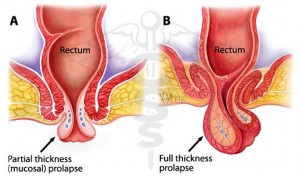 Image of Rectal Prolapse