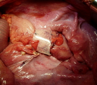 Picture of Rectal Prolapse