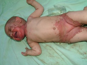 Image of Acrodermatitis enteropathica