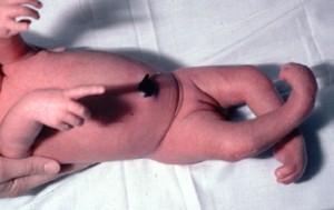 Picture of Arthrogryposis