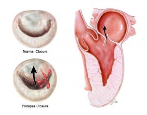 Image of Mitral valve prolapse