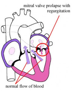 Picture of Mitral valve prolapse