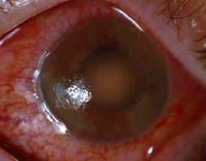 Image of Narrow Angle Glaucoma 