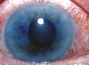 Picture of Narrow Angle Glaucoma 