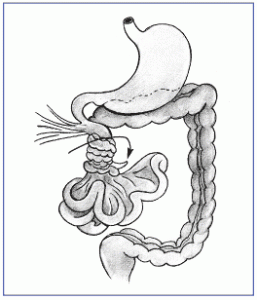 Picture of Volvulus