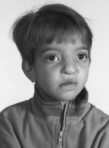 Image of Wolf-Hirschhorn Syndrome
