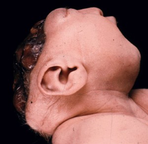 Image of Anencephaly