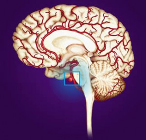 Image of Cerebral Aneurysm