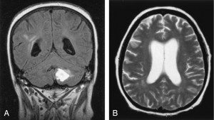 Image of Cerebral Vasculitis