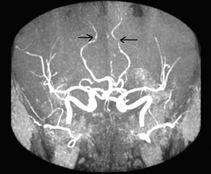 Picture of Cerebral Vasculitis