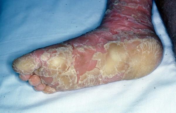 Epidermolytic Hyperkeratosis - Types, Causes, Symptoms and 