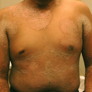 Picture of Epidermolytic Hyperkeratosis