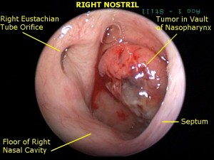 Picture of Nasopharyngeal carcinoma