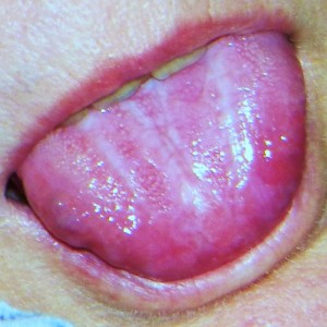 Image of Oral Lichen Planus