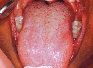 Picture of Oral Lichen Planus