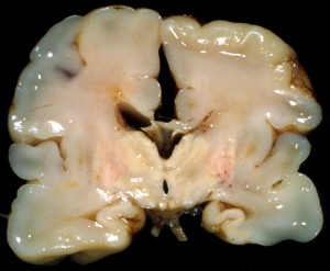 Image of Periventricular leukomalacia