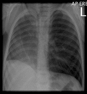 Image of Scimitar Syndrome