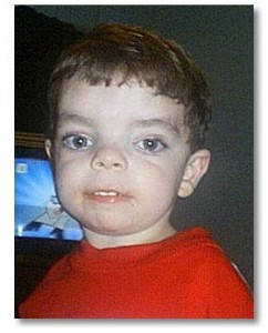 Picture of Aarskog Syndrome