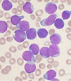 Picture of Acute Lymphoblastic Leukemia