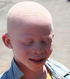 Picture of Albinism