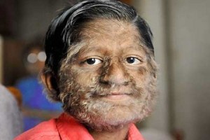 Image of Argyria