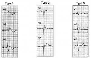 Image of Brugada Syndrome